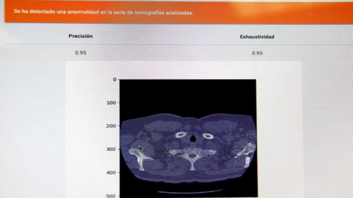 Alumnos del IPN crean sistema para diagnosticar cáncer de pulmón