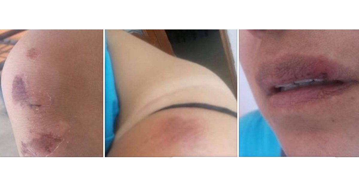 Cesan a funcionario de ayuntamiento de Oaxaca por golpear a su ex novia - presuntas-lesiones-a-ex-pareja-de-funcionario-de-oaxaca