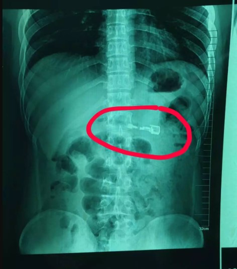 #Video Extraen encendedor a joven que se lo tragó - radiografia-de-la-ubicacion-de-la-pila