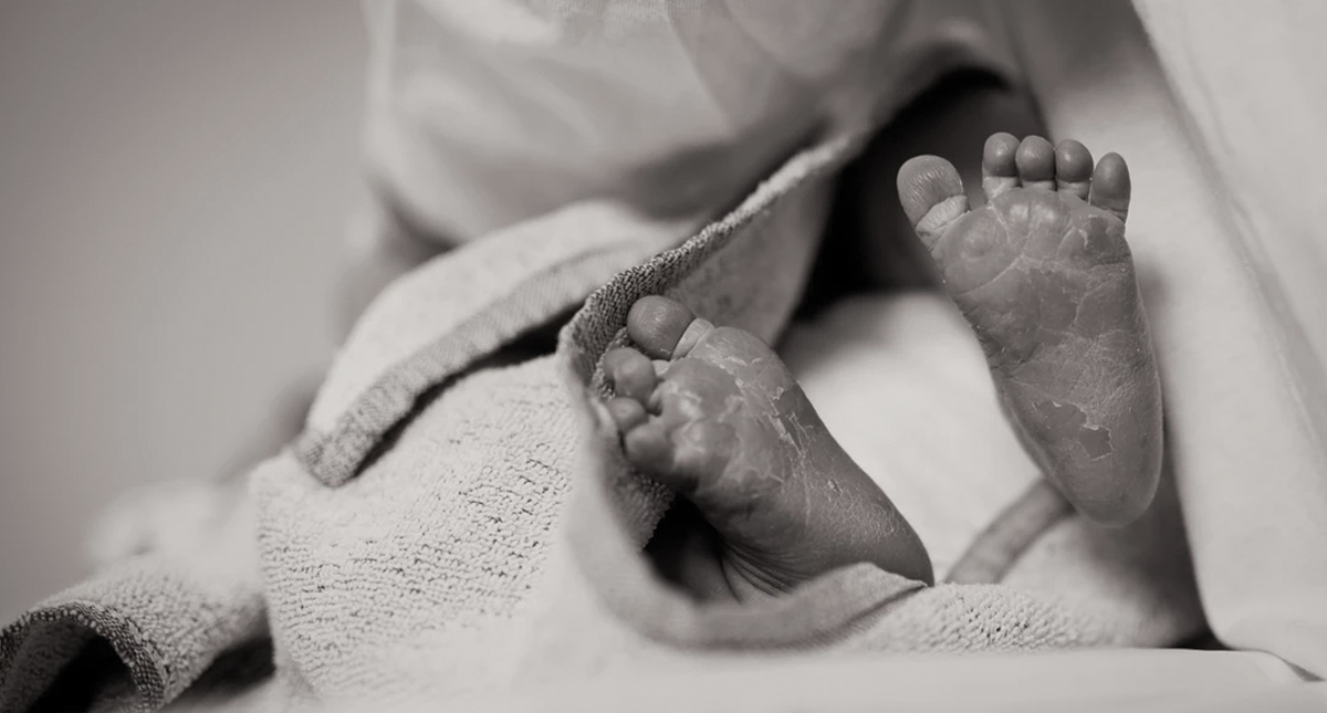 Bebé nace sin piel en Texas