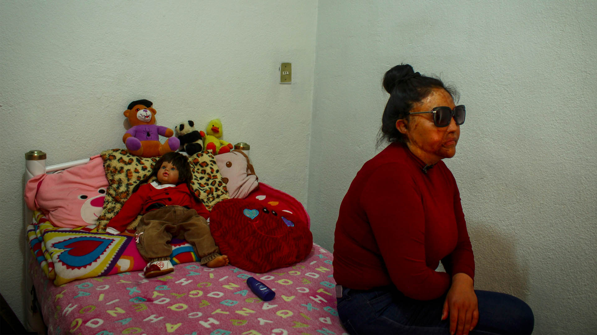 Ataque con ácido lastimó mi piel y mi vida: víctima de violencia