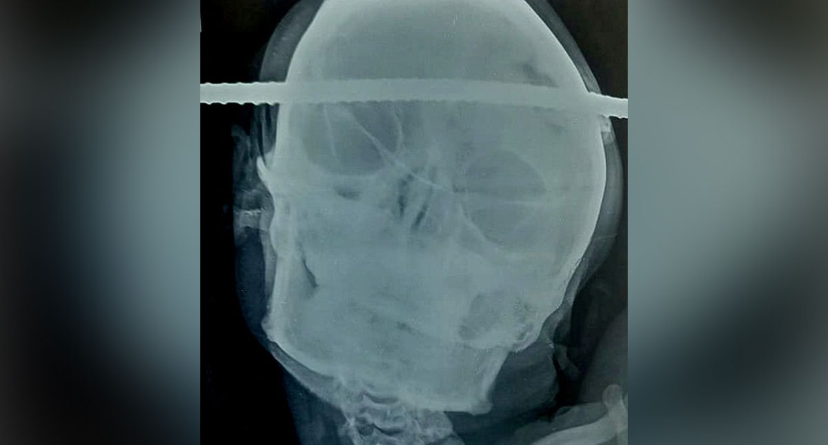 #Video Sobrevive hombre que cae a pozo y una varilla le atraviesa la cabeza