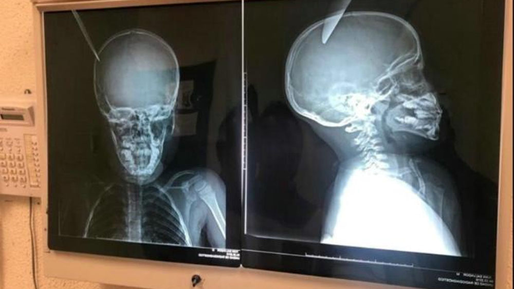 Niño de ocho años apuñala en la cabeza a menor de cinco en Sonora Niño de ocho años apuñala en la cabeza a menor de cinco en Sonora