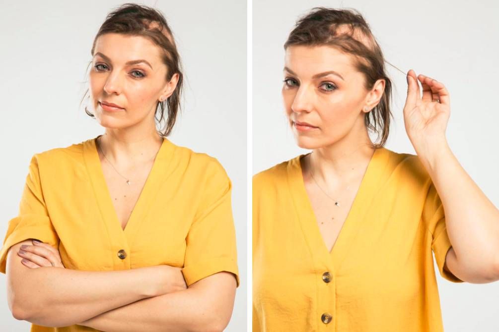 Novia pierde casi todo su pelo por planificar su boda - novia-alopecia-boda