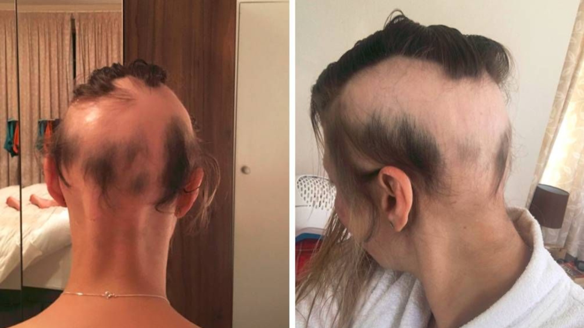 Novia pierde casi todo su pelo por planificar su boda