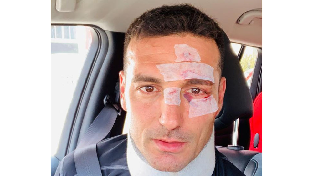 Dan de alta a Lionel Scaloni tras ser atropellado Dan de alta a Lionel Scaloni tras ser atropellado