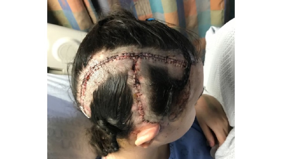 Consideran a adolescente como 'milagrosa' por sobrevivir a aneurisma - chole-tras-su-craneotomia