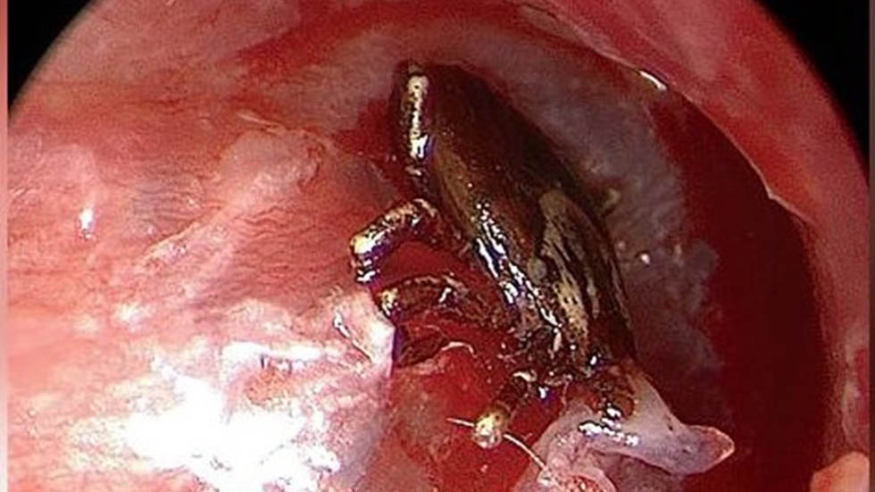 Garrapata se aloja en oído de niño de nueve años