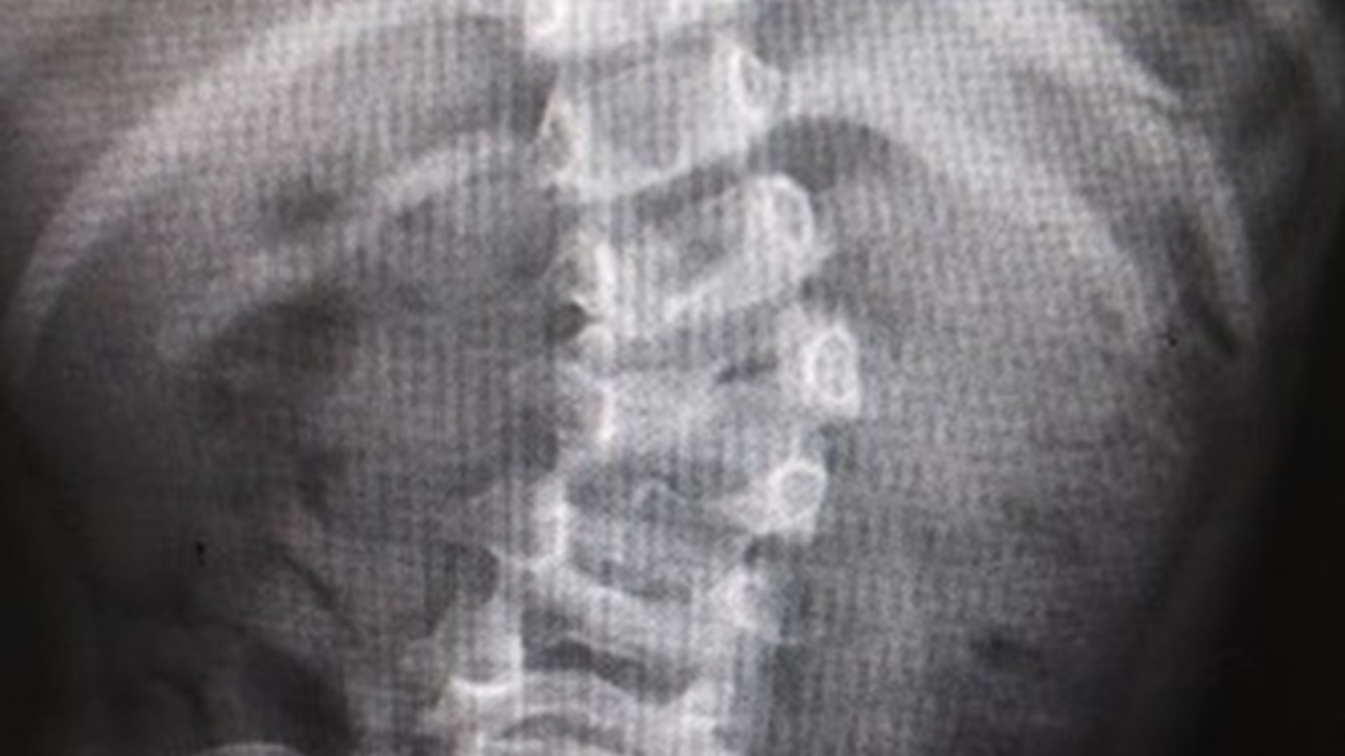 Corrigen malformación de columna a niña de 4 años en el IMSS - escoliosis-congenita