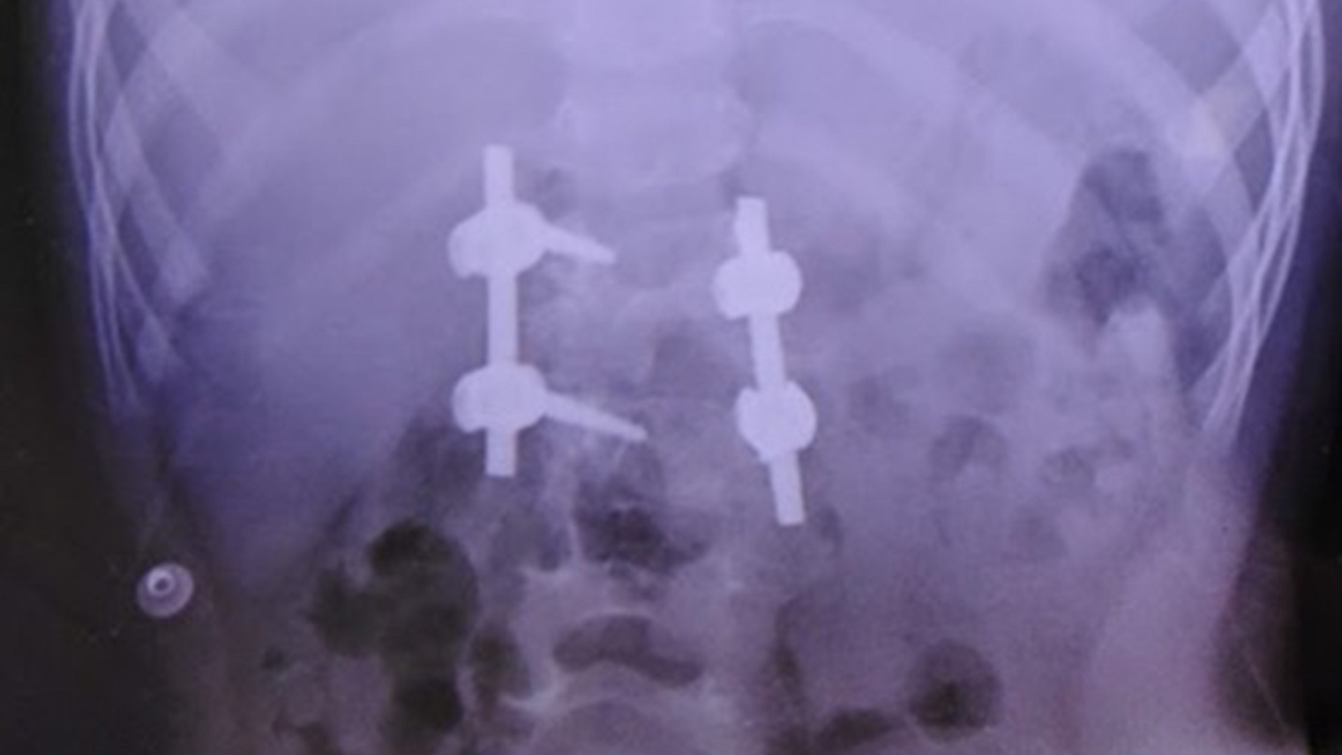 Corrigen malformación de columna a niña de 4 años en el IMSS - implantes-pediatricos