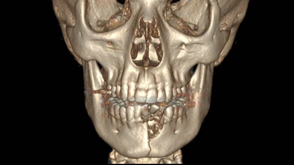 Cigarro electrónico explota y le rompe la mandíbula a joven