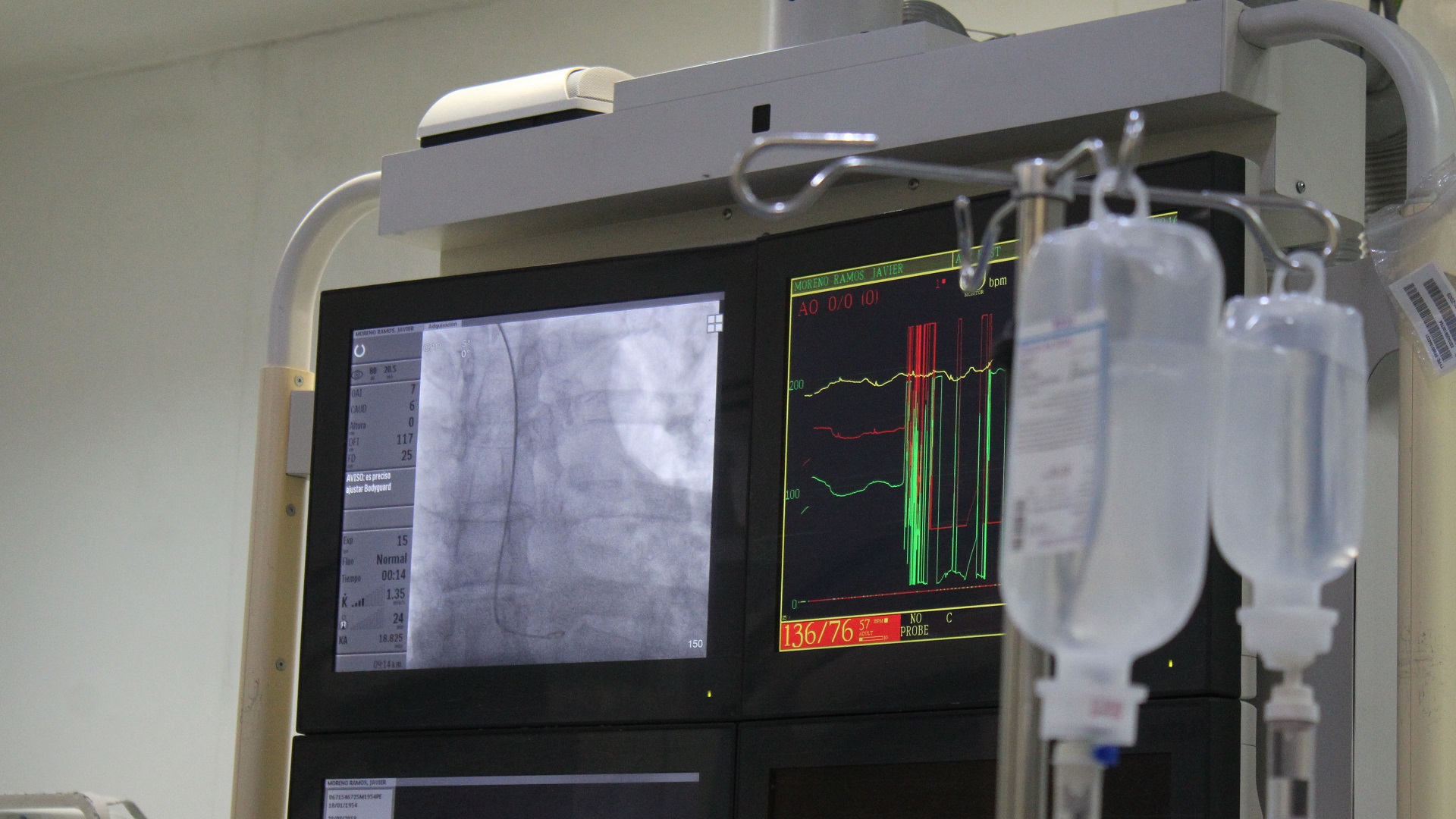 IMSS trata enfermedades del corazón a través de la muñeca - monitor-para-ver-la-arteria-hacia-el-corazon