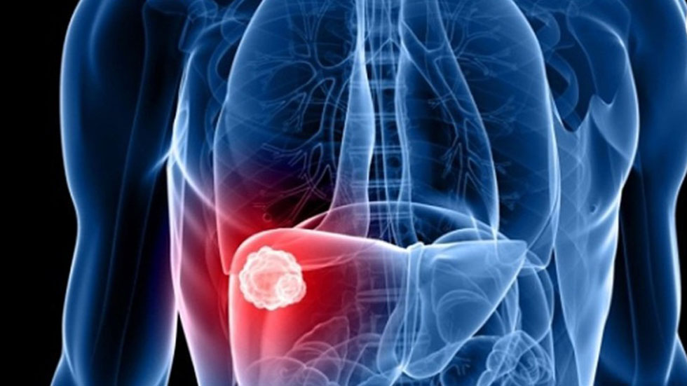 Prevalencia de hepatitis es alta en México Prevalencia de hepatitis es alta en México