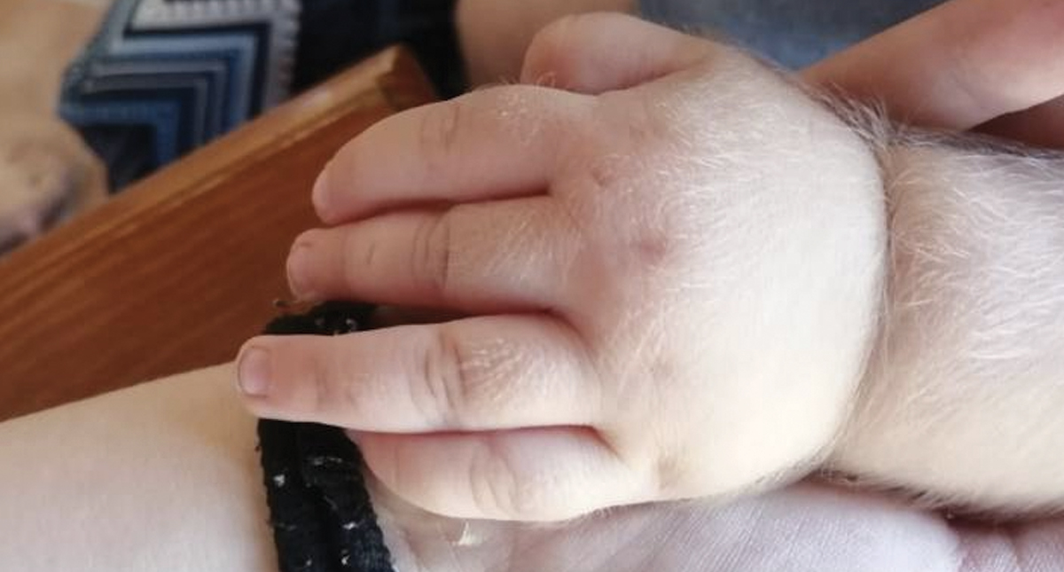 Retiran medicamento que provocó síndrome de hombre lobo a bebés