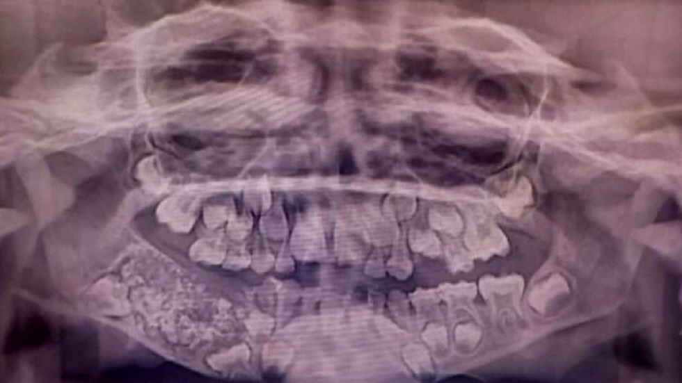 Extraen 526 dientes a niño de siete años en India - tumor-en-la-mandibula-inferior-del-nino