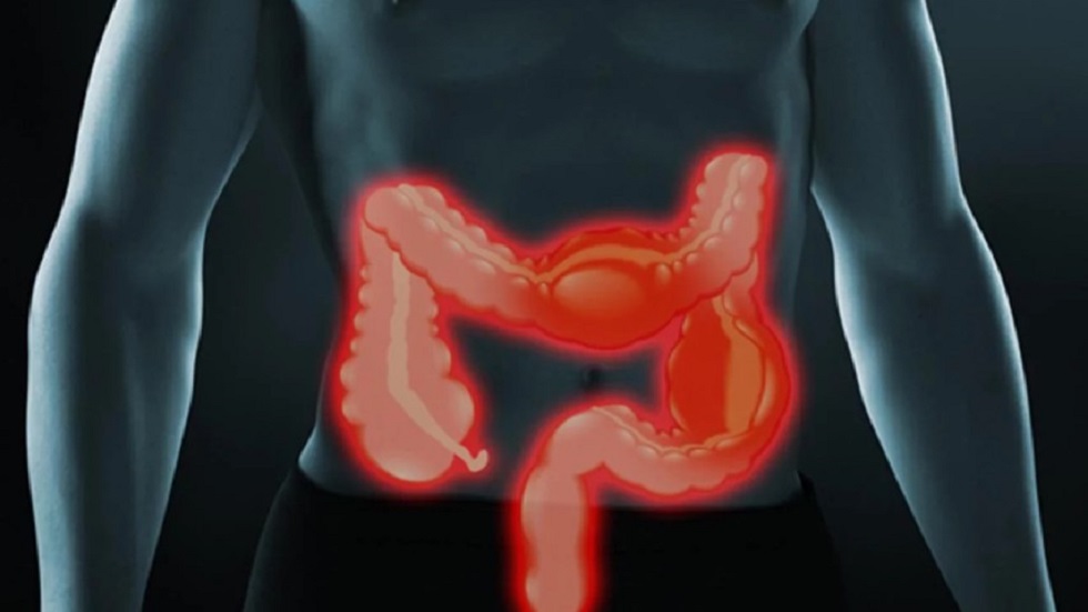 Enfermedad inflamatoria intestinal afecta a jóvenes mexicanos