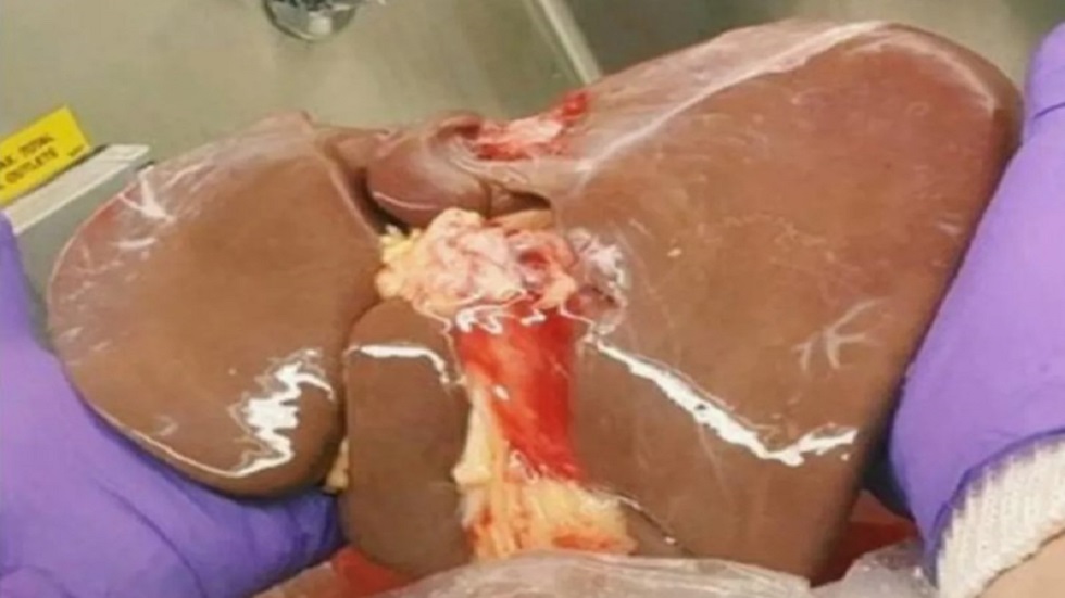 Nueva técnica alarga preservación de hígados para trasplantes - higado-despues-de-preservacion-hipotermica