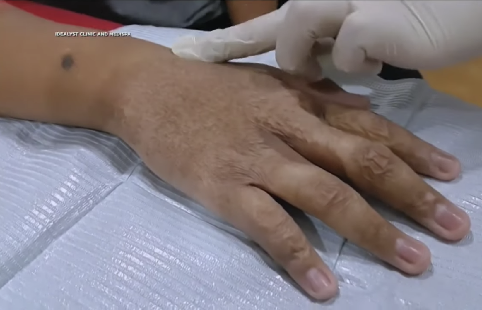 La UNAM crea parche cicatrizante La UNAM crea parche cicatrizante