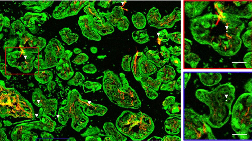 Detectan partículas de carbono negro en placenta de embarazadas - particulas-de-carbono-negro-presentes-en-el-tejido-placentario