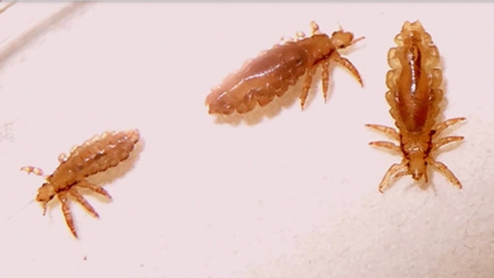 IMSS urge a evitar automedicación y remedios caseros por piojos - piojos