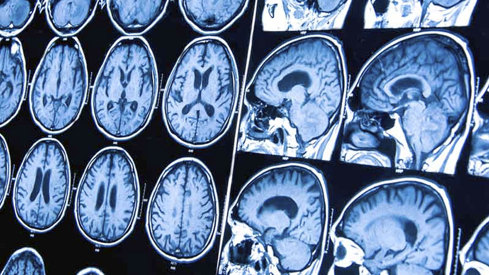 Científicos hallan en ratones cómo neutralizar letal tumor cerebral