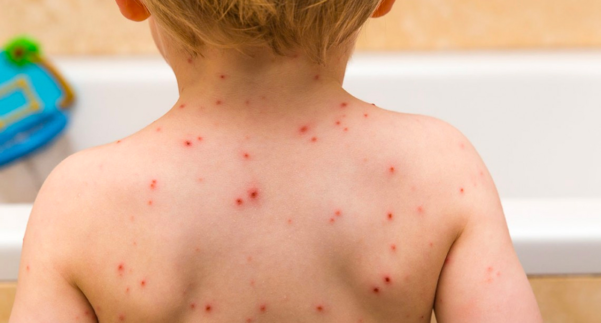 ¿Cómo prevenir contagios de varicela?