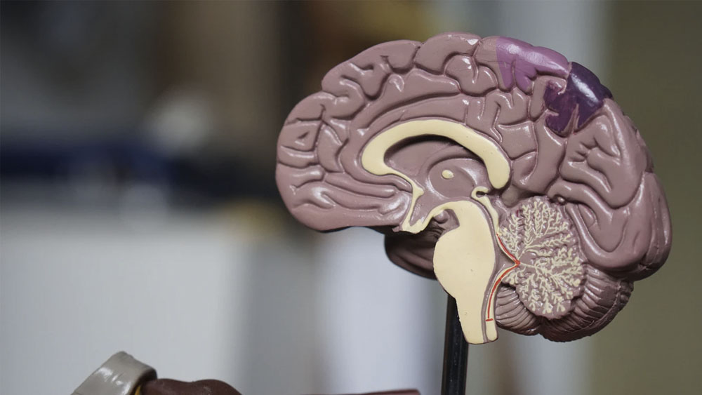 En México se registran 170 mil casos de infarto cerebral al año