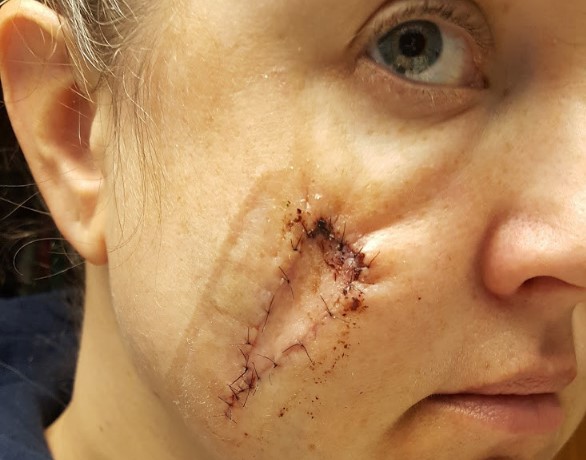 Camas de bronceado dejan 'hoyo' en cara de mujer - melanoma-de-natalie-por-exposicion-al-sol-y-uso-de-camas-de-bronceado