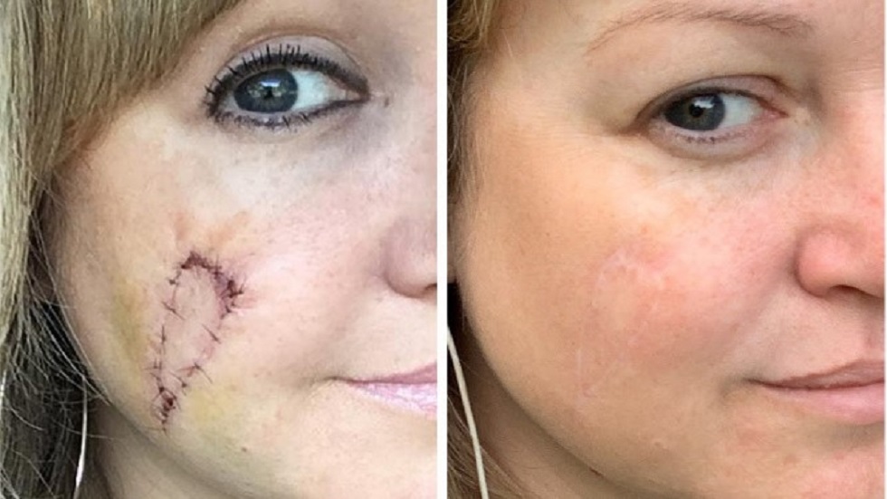 Camas de bronceado dejan 'hoyo' en cara de mujer - melanoma-extirpado-a-natalie-trout