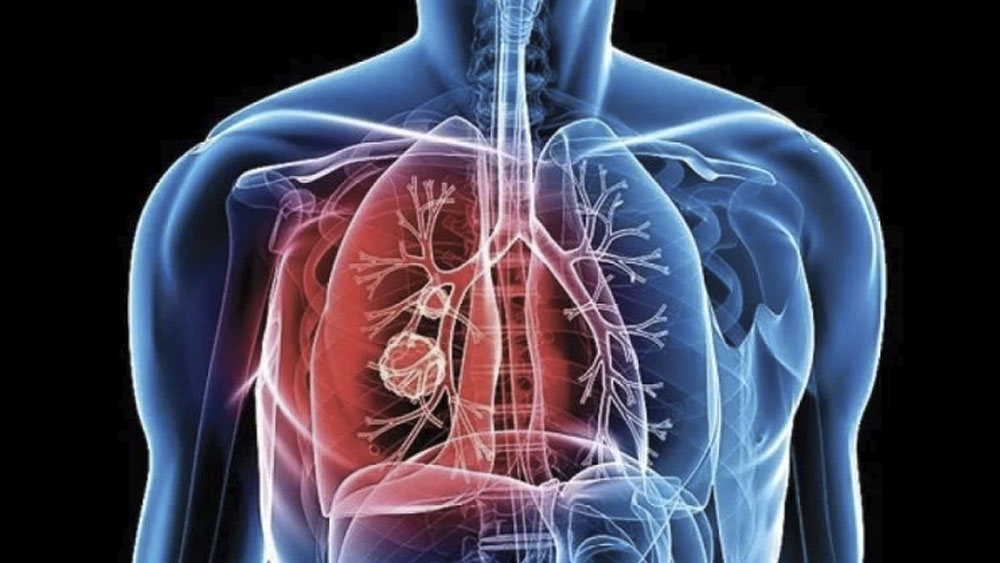 Tuberculosis se puede transmitir en estado de latencia: científicos