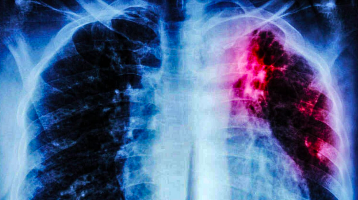 Descubren mecanismo que provoca que la tuberculosis sea virulenta