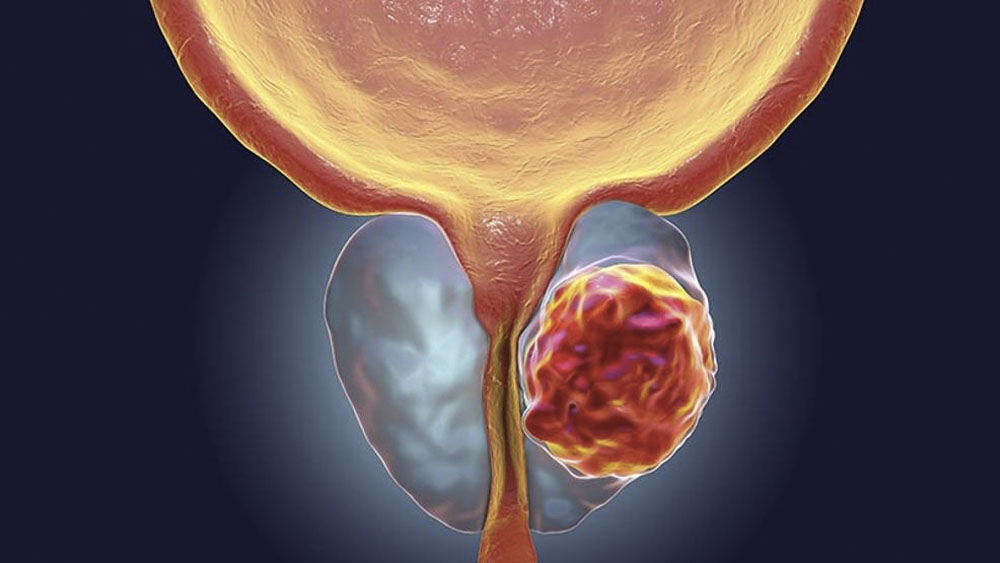 Cáncer de próstata, primera causa de muerte por neoplasias en México