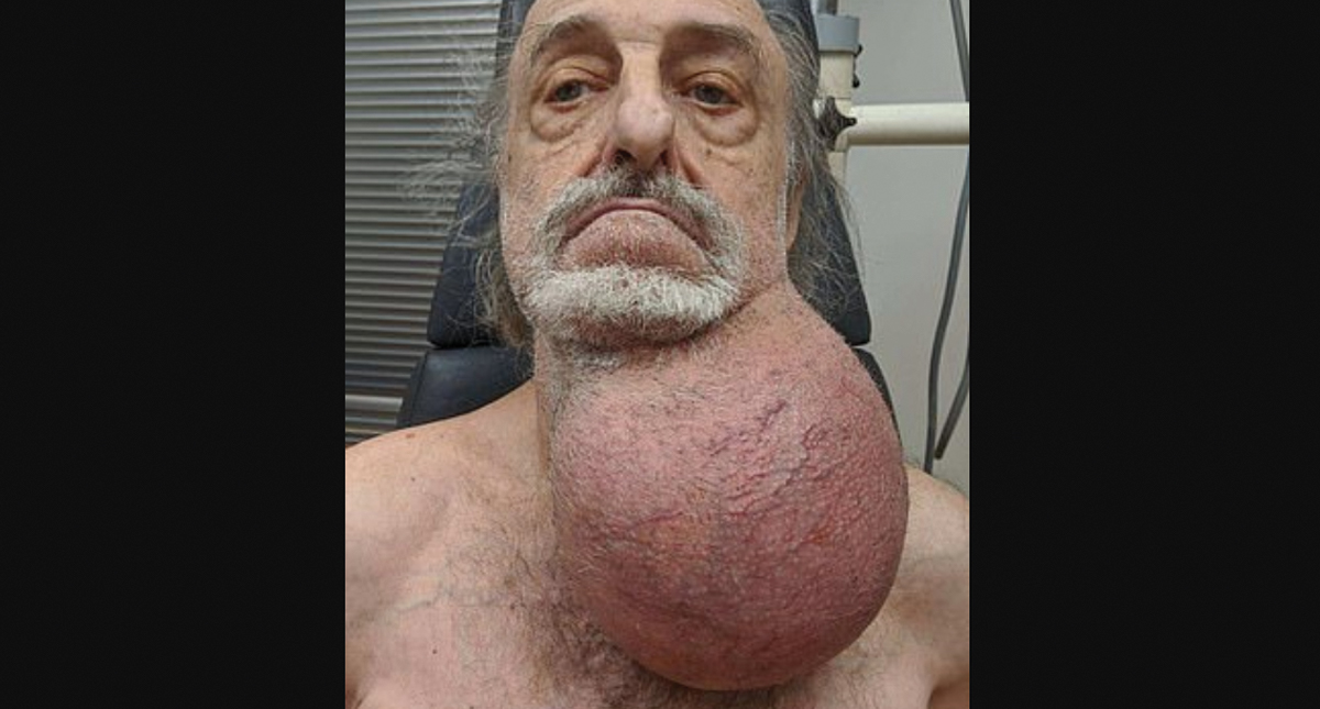 Extraen tumor del tamaño de un melón de cuello de hombre en EE.UU. - cancer