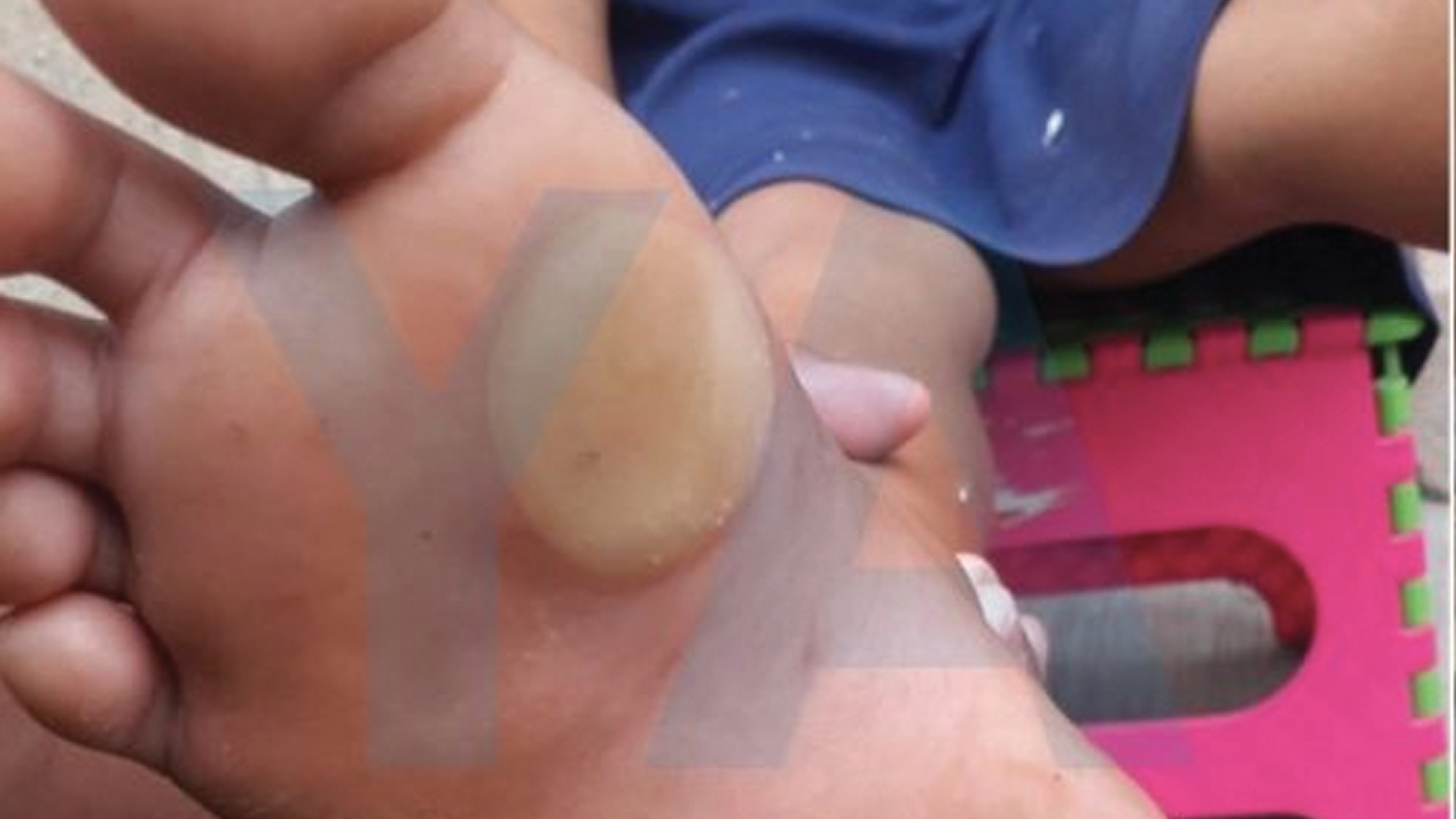 Mujer quema pies con una plancha a su hija por haberla desobedecido - quema-a-nina