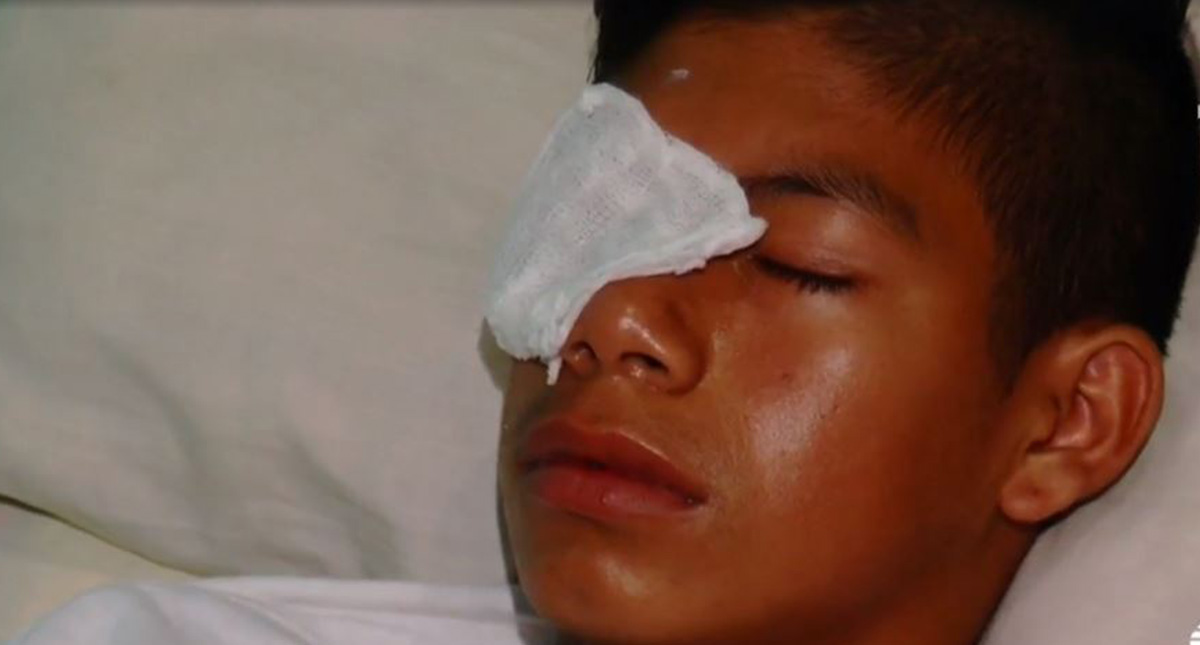 Adolescente de 14 años a punto de perder la vista por bullying en México - adolescente-jose-angel-perez