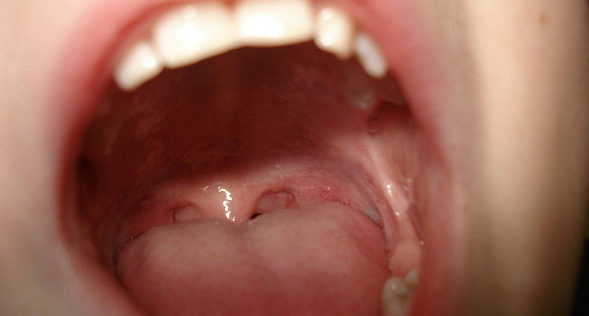 Científicos rusos proponen método con láser para tratar la leucoplasia