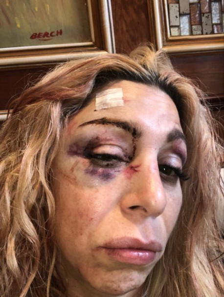 #Video Golpean a actriz y a modelo en bar de Nueva York - heridas-de-jennifer-agostini