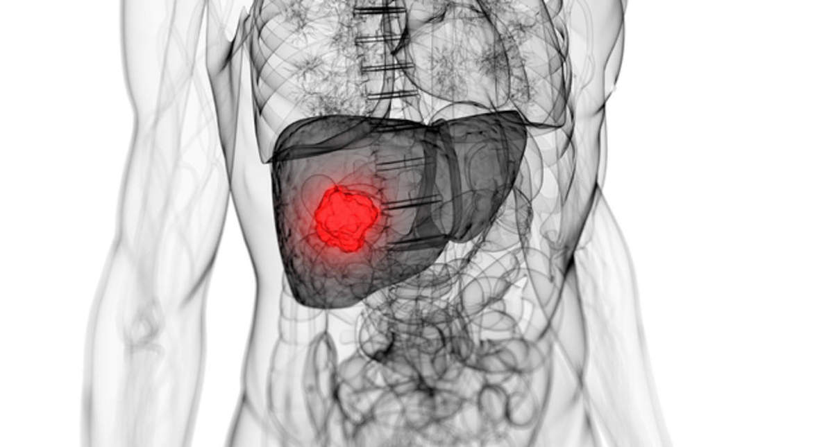 Aumentan casos por hepatitis A en niños