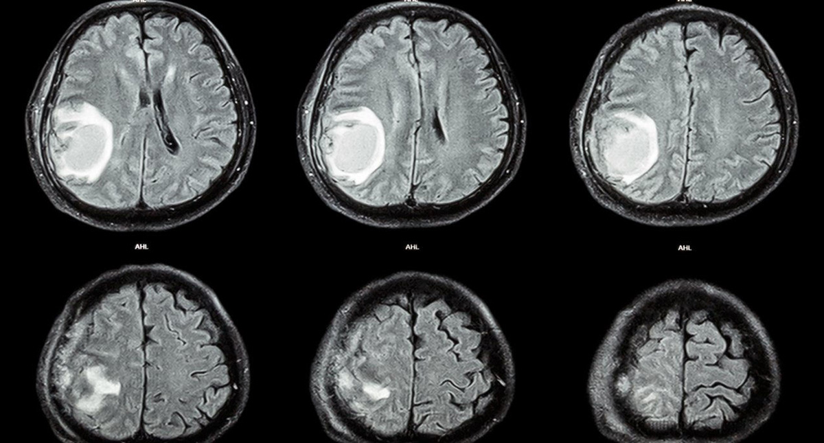 Hallan que mecanismo celular está implicado en tumor cerebral