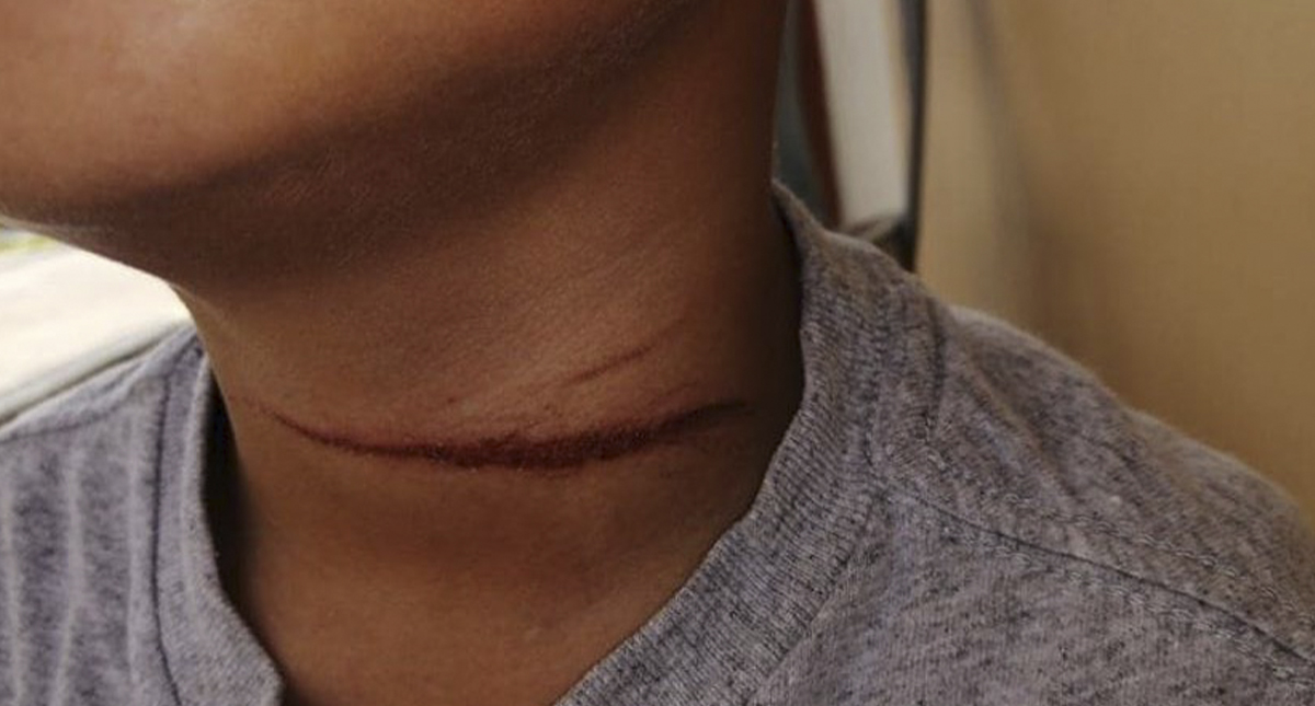 Niño corta garganta a compañero en escuela primaria de Veracruz - cicatriz-de-la-herida-punzocortante-de-un-menor-de-edad