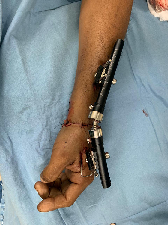 Reimplantan mano amputada a paciente en hospital de Villahermosa - mano-reimplantada-a-hombre-en-tabasco