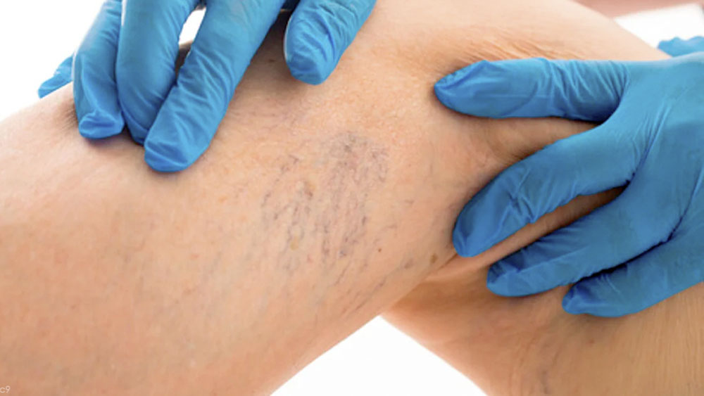 Obesidad aumenta riesgo de padecer várices, afirma especialista