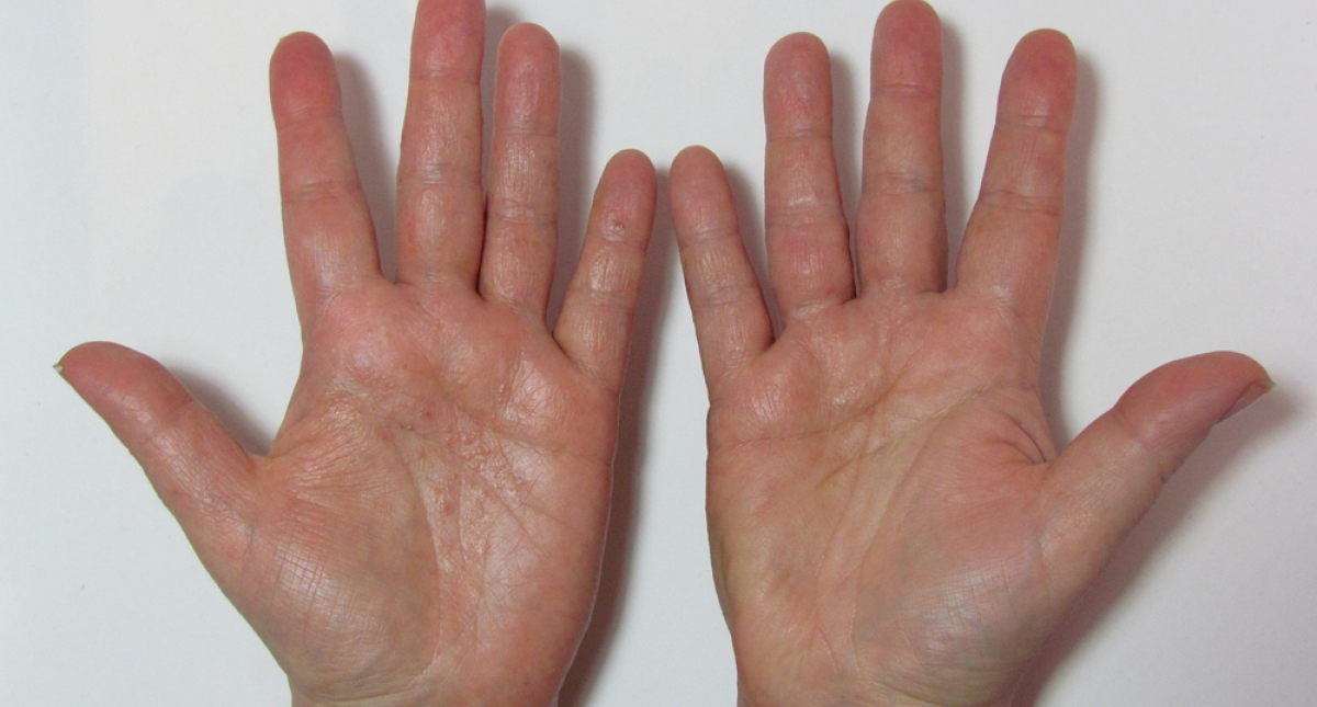 Estas son las cinco manifestaciones del COVID-19 en la piel