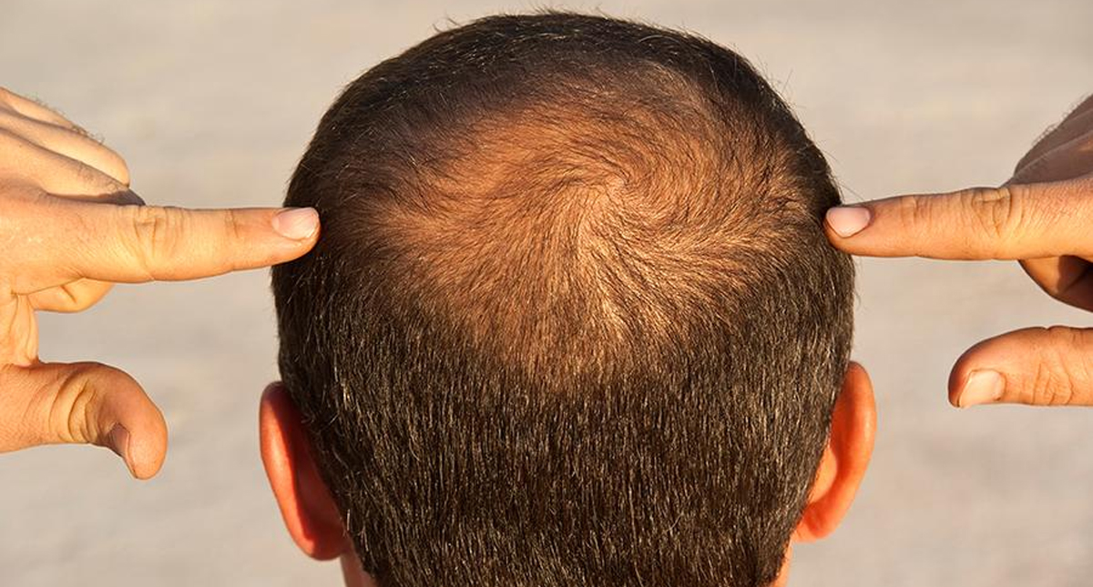 Células madre generan crecimiento de cabello en personas con alopecia: ensayo clínico