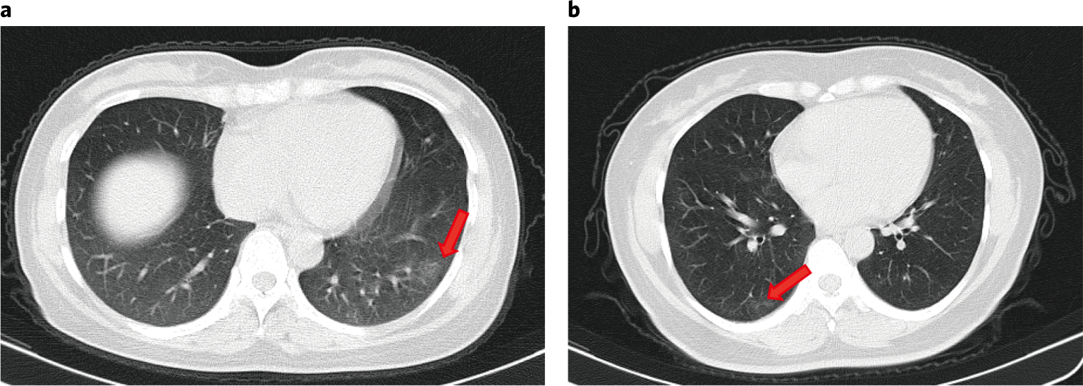 Inmunidad ante COVID-19 no tendría efecto a largo plazo, alertan estudios - pulmones-covid-19