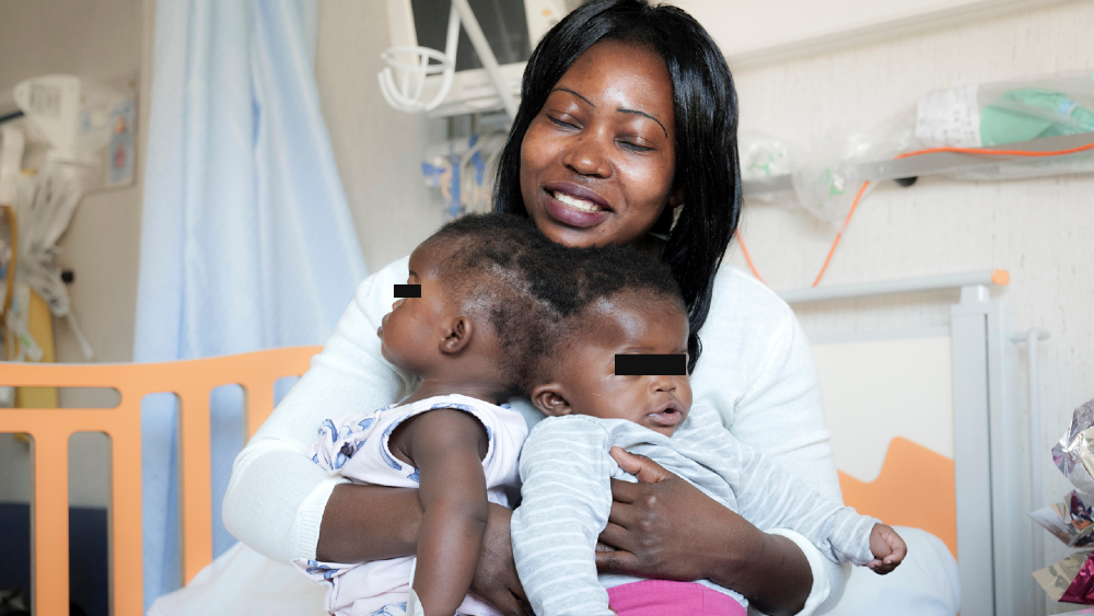 Separan con éxito en Roma a dos siamesas unidas por el cráneo