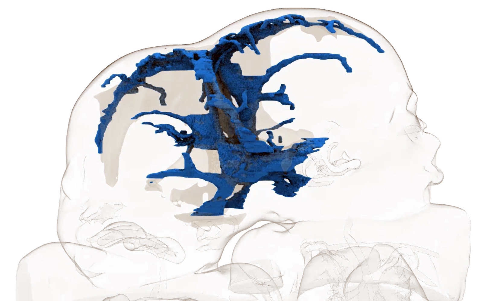 Separan con éxito en Roma a dos siamesas unidas por el cráneo - siamesas-roma-craneo-2