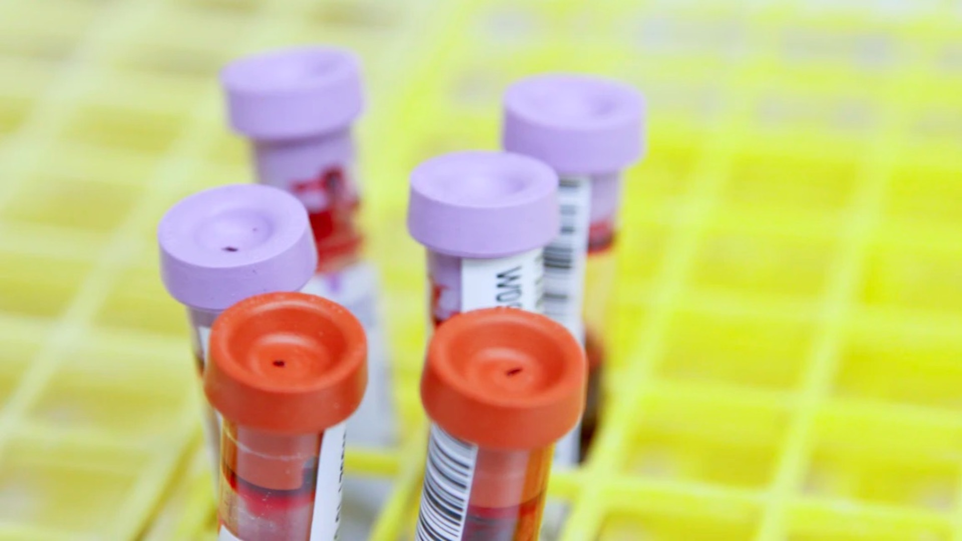 La sífilis se habría propagado por Europa antes de que Colón descubriera América