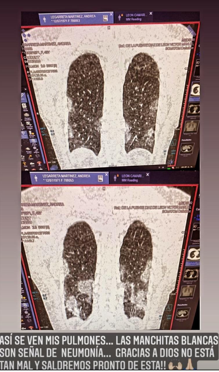 Sale Andrea Legarreta del hospital tras ser ingresada por neumonía - andrea-legarreta1