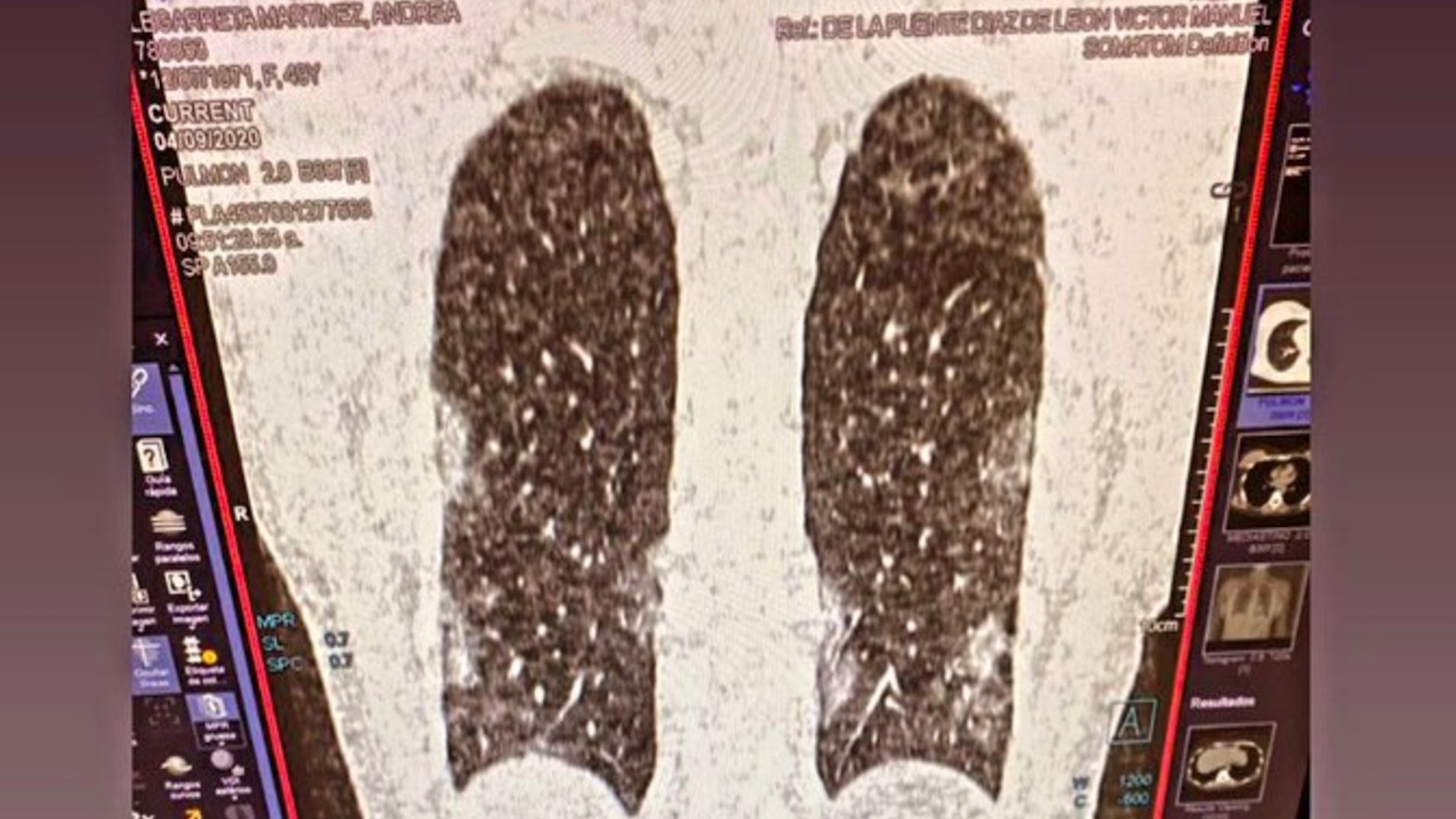 Tomografía indica neumonía en pulmones de Andrea Legarreta; asegura que está estable